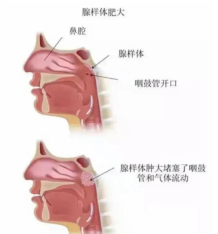 嗯哼近照疑腺样体面容引不适议腺样体面容尽早治疗，别不当回事