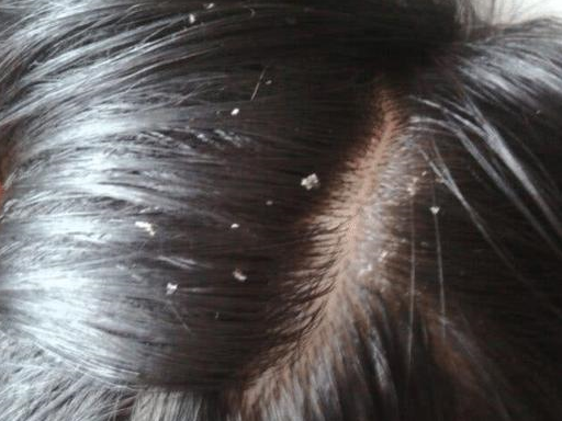 原创
            简单按摩手法，帮您轻松去除头皮屑，避免尴尬，减轻困扰丨怎么头皮按摩可以减少掉发