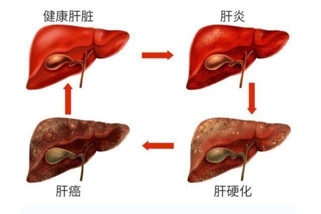 ​肝硬化严重程度区分标准