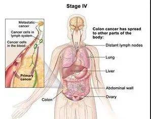 结直肠癌筛查怎么做?这几个知识点你必须知道！插图8