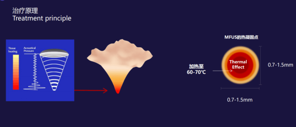 弥散区域，聚焦点周围组织热损伤更小；治疗更安全舒适，术后恢复更快。