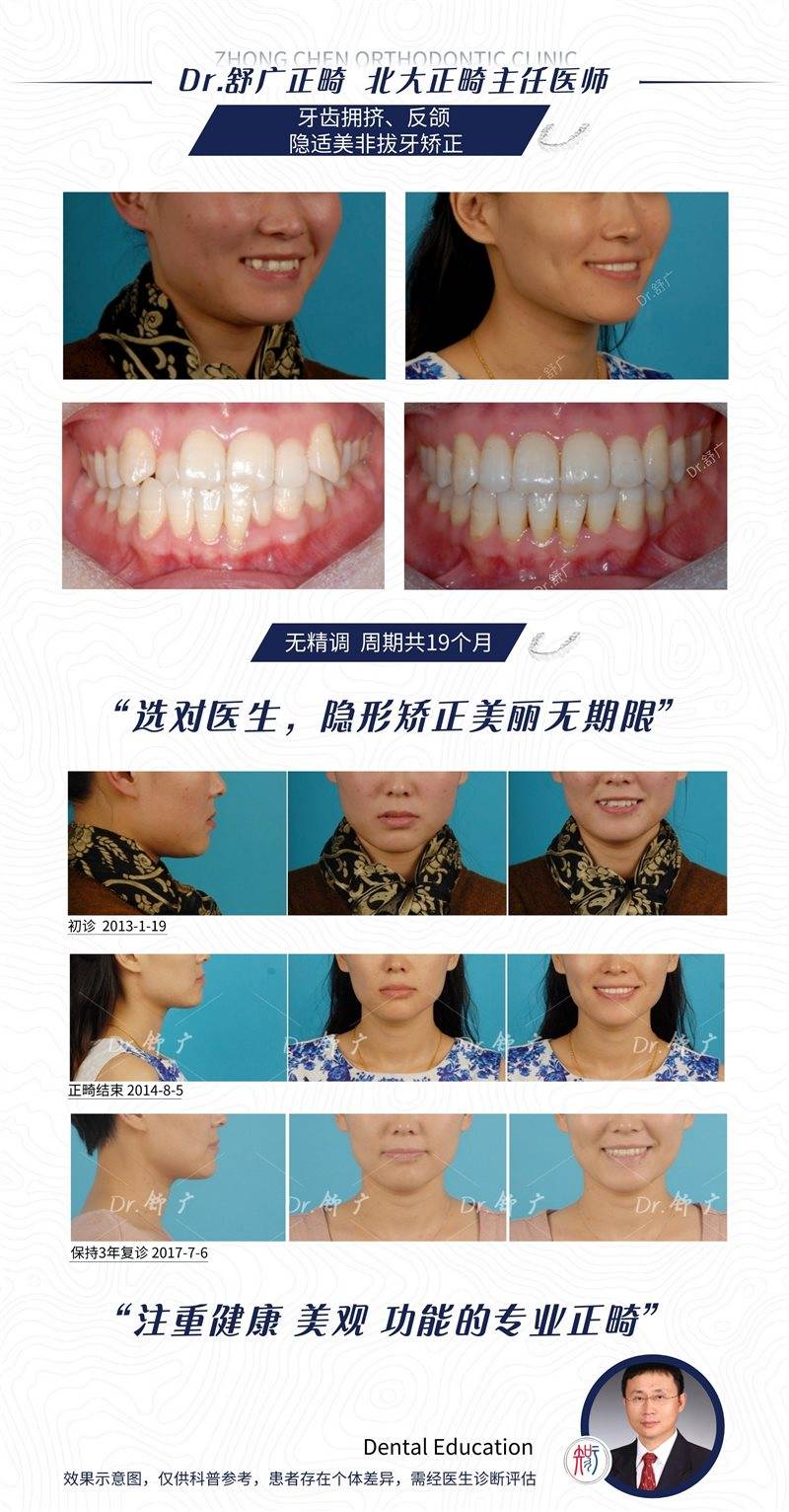 隐适美隐形牙齿矫正需要微调几次