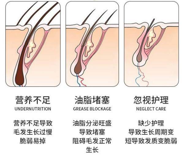 洗什么洗发水可以防脱发？让你头发越洗越多!