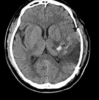死地只有一招可以破解!脑组织被挤变形?这种快速置人于死地的危重状态