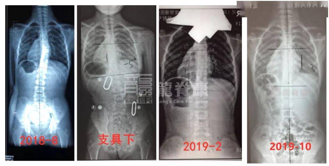 2018年(9岁)复查时,没想到侧弯度数已经增至18°,剃刀背10°!