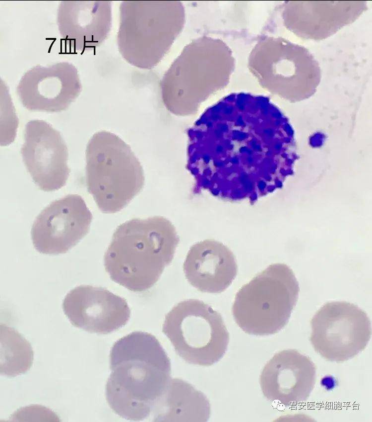 6 ▼ 「异型淋巴细胞」 形态特征:胞体较大,类圆形,胞浆量丰富,深