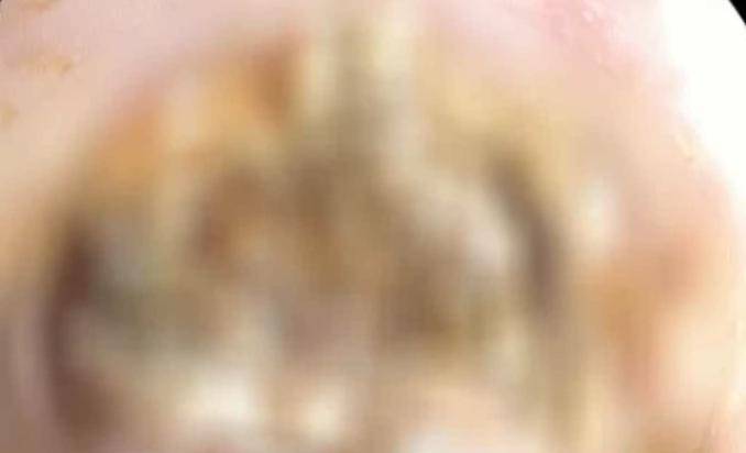 [气管]广西3岁女孩误吞异物,卡在气管与食管交接处,这东西很多家庭都有