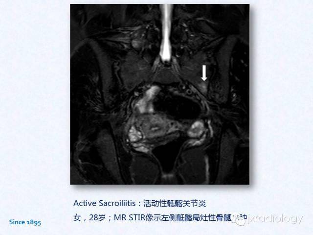 骶髂关节炎:x线,ct和mri表现