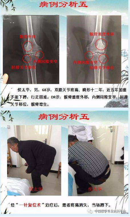 全国第七届松骨针疗法临床实践高级研修班 暨第十六期膝关节畸形一针