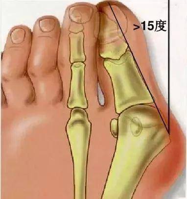 在医学上也被称为拇囊畸形,即:第一跖骨内翻 拇指外翻.