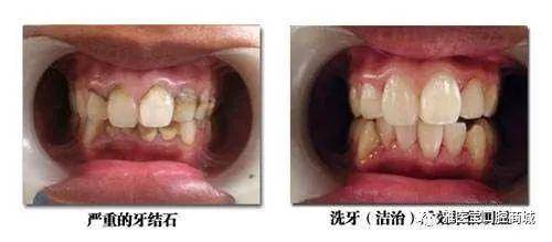 牙龈消肿后  露出了正常的牙间隙,所以会  感觉牙缝大了