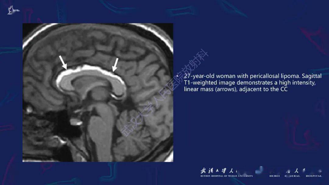 胼胝体病变影像诊断