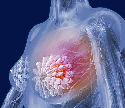 很多乳腺癌没有症状,一发现就是晚期!