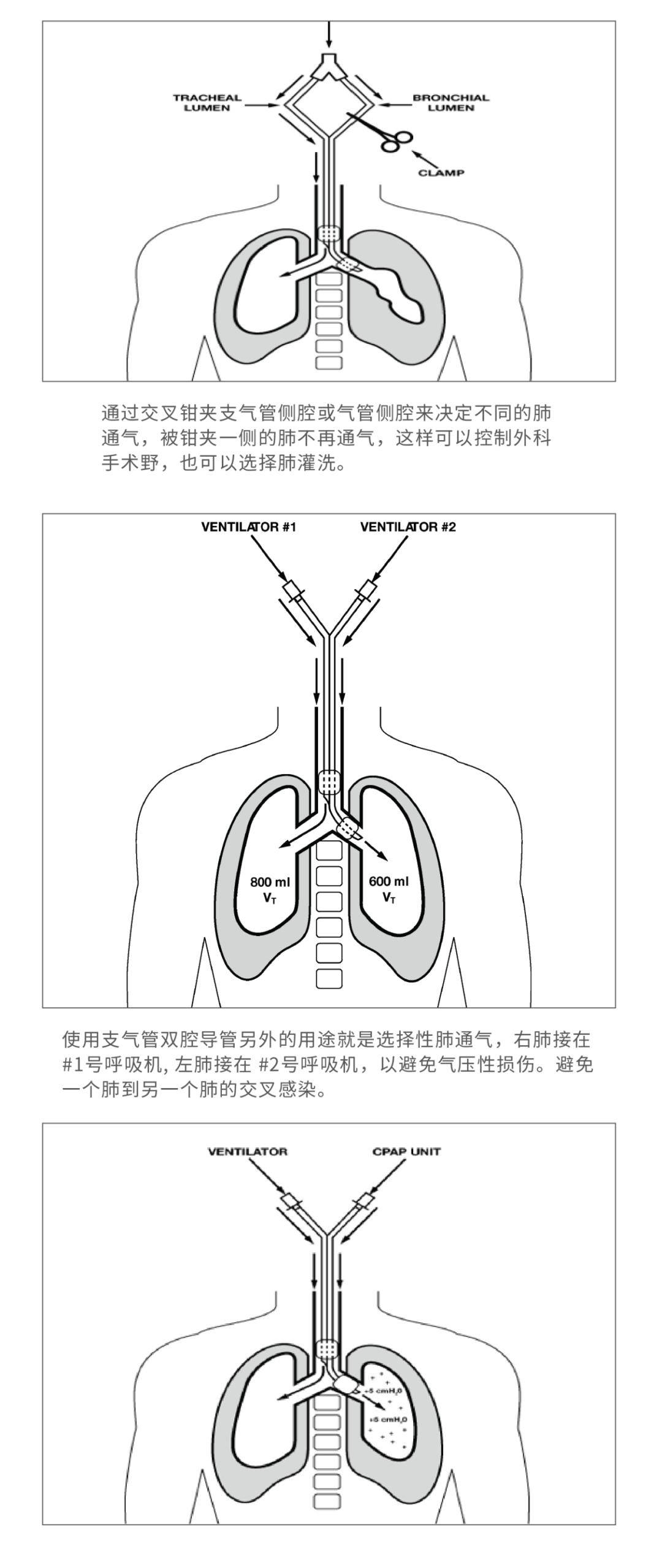 气管插管真的选对了吗