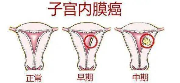 【华西生殖—女性小知识】子宫内膜增生的长期管理之曼月乐篇