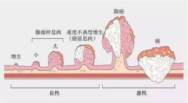 息肉,不切掉,迟早会变坏除了此处癌肿之外,还在乙状结肠,横结肠发现数