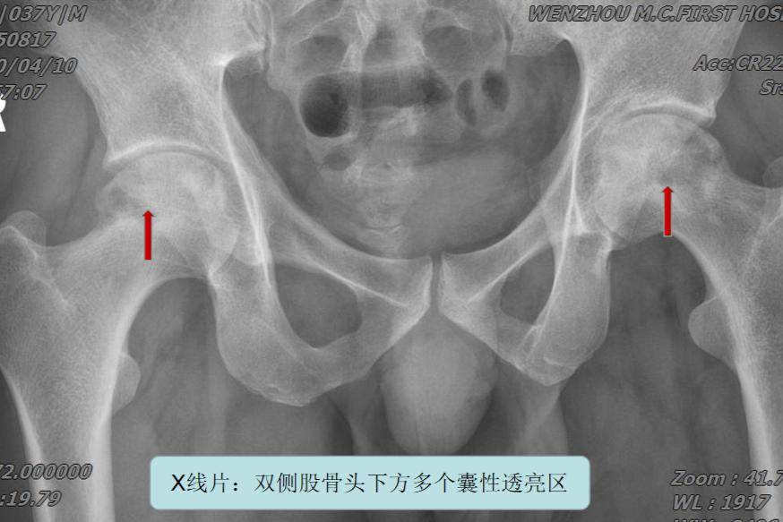 一医青年专家说科普丨关节外科陈鑫:股骨头坏死了怎么办?