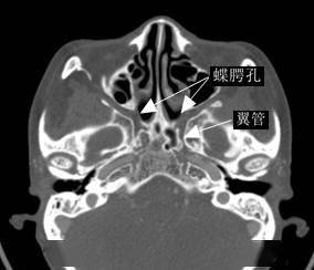 外:翼上颌裂---颞下窝下:翼腭管---腭大,小孔---口腔翼腭窝连续ct显示