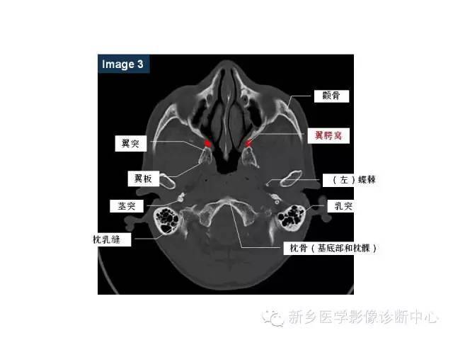 鼻咽部的详细解剖(含各个孔道)