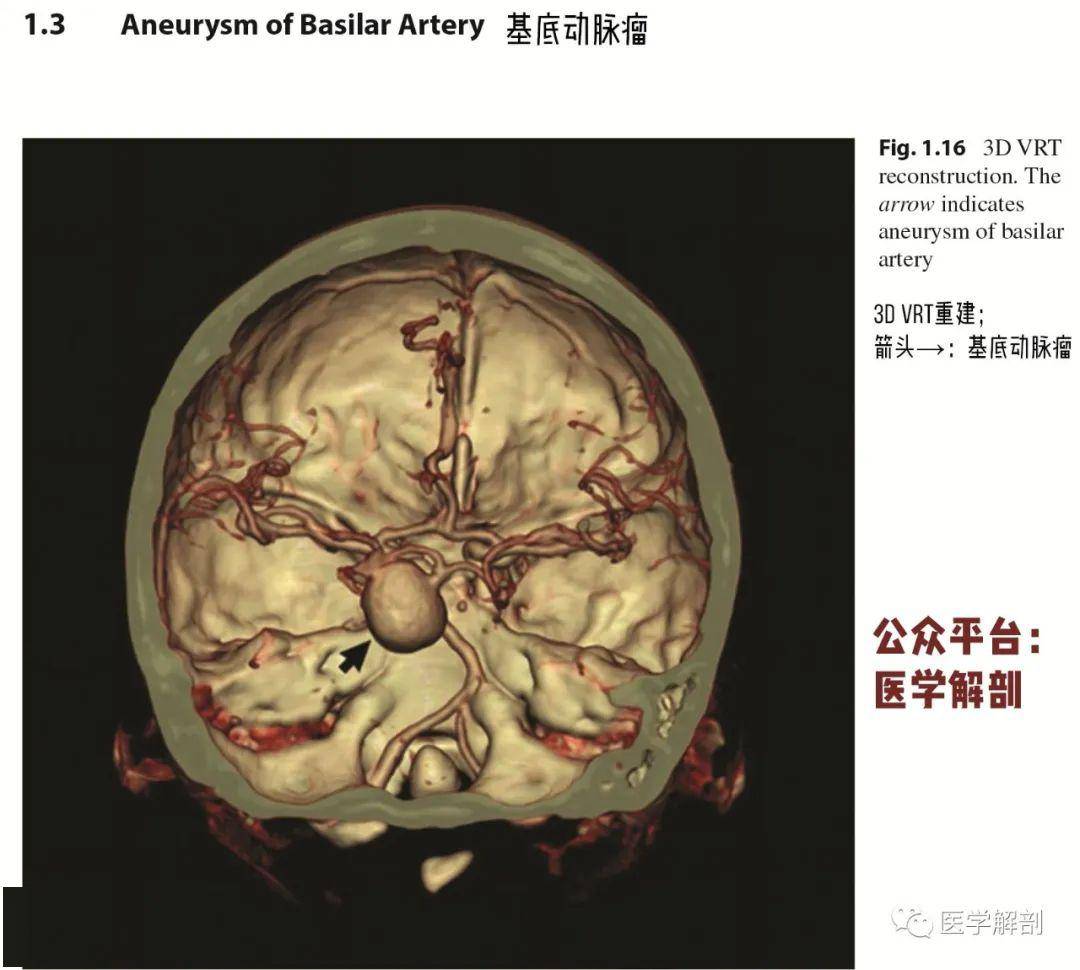 脑cta图谱 | 基底动脉瘤_解剖