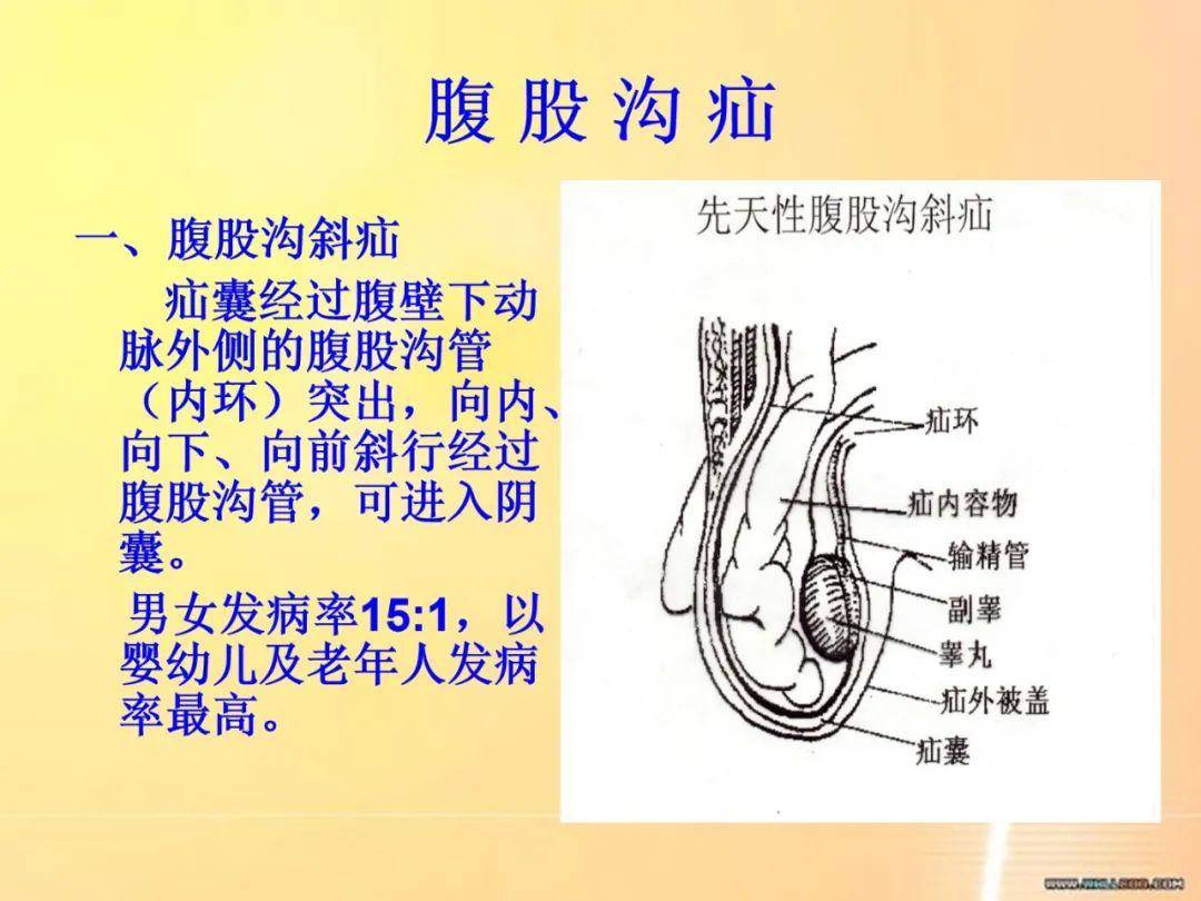 老年患者常见疾病—疝气的护理