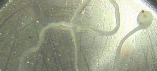 寄生虫|夏季这几种食物家长不要再给孩子吃了！8岁男童肝脏内长满了虫子