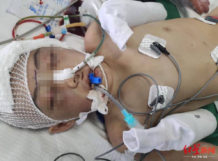 恒耀平台注册山西怀仁12岁女童疑遭继母虐待致脑梗死,检方提前介入 (图4) 恒耀平台注册山西怀仁12岁女童疑遭继母虐待致脑梗死,检方提前介入 (图4)
