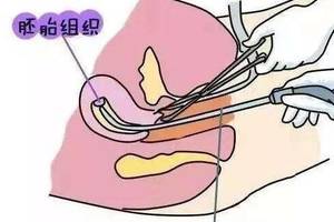小心!人流清宫手术可能会导致不孕!