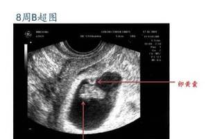 孕早期,看懂b超上7个指标,胎宝宝不再有"秘密"