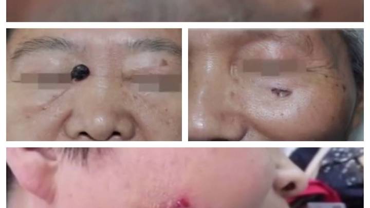 皮肤溃疡久不愈,患上癌症,你还会去医院检查吗?