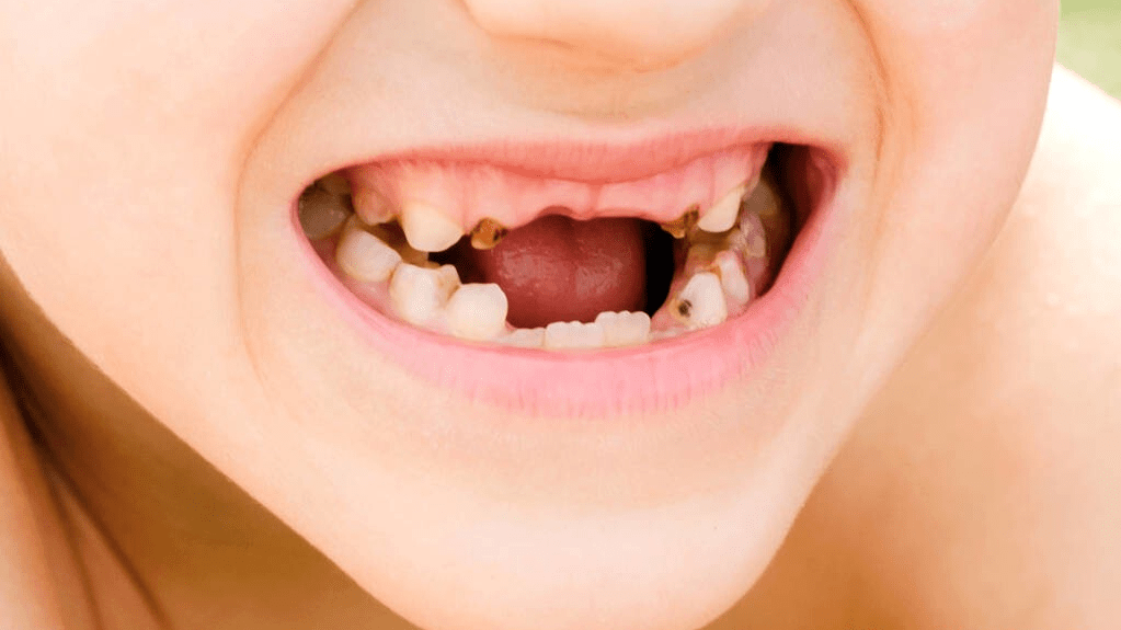 4 小朋友乳牙蛀牙,不用管,因为乳牙会替换?