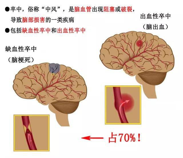 包括脑出血,脑梗死等