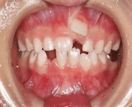 为什么孩子换牙期居然变成了锯齿牙?