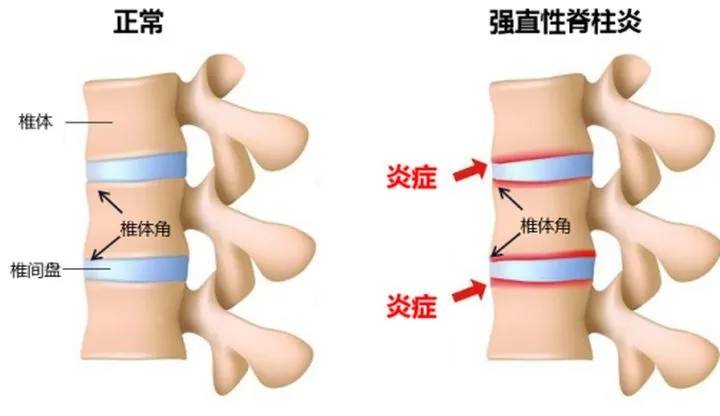 成都医大医院:强直性脊柱炎,是如何发展至弯腰驼背的?