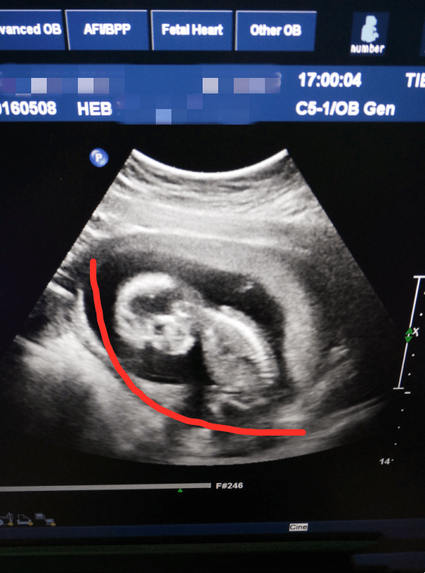 孕14周 3,b超特别清晰,宝宝低着头,脊椎都看得非常清楚,真的好神奇啊!