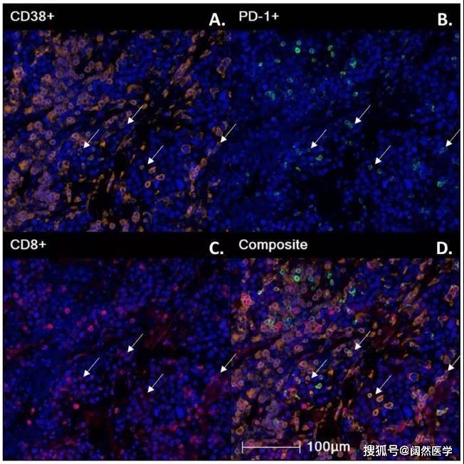 基于多重荧光免疫组化技术(mihc)分析hcc患者免疫治疗后肿瘤微环境,如