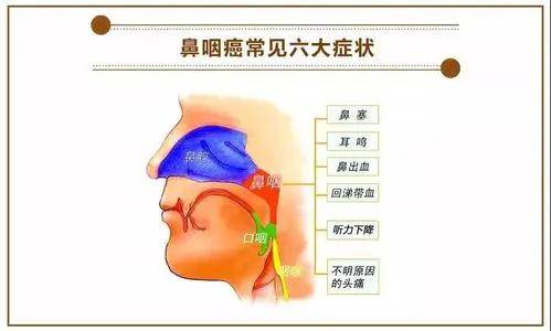 发生于咽隐窝的鼻咽癌患者,早期可压迫或阻塞咽鼓管咽口,引起耳鸣,耳