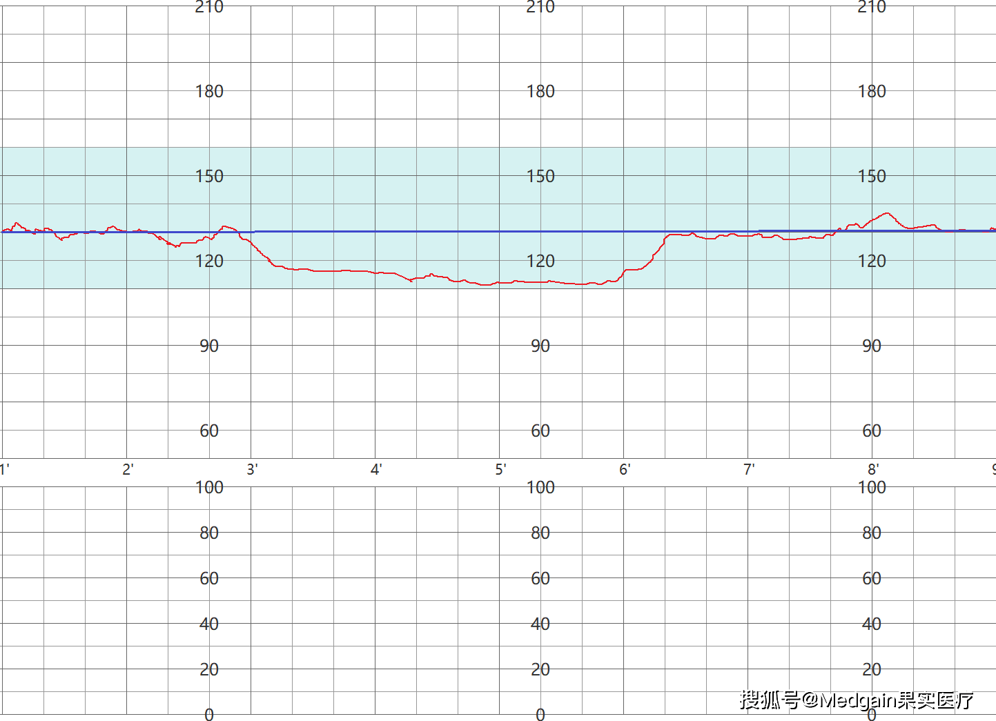 胎心监护过程中出现的延长减速图型