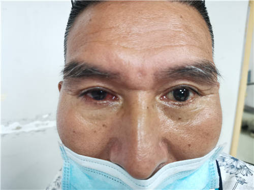 喻维初因新生血管性青光眼在武汉普瑞眼科医院进行了眼球摘除手术