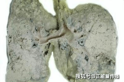 痰中带血或咳血是肺癌的常见症状,多见于中型肺癌.