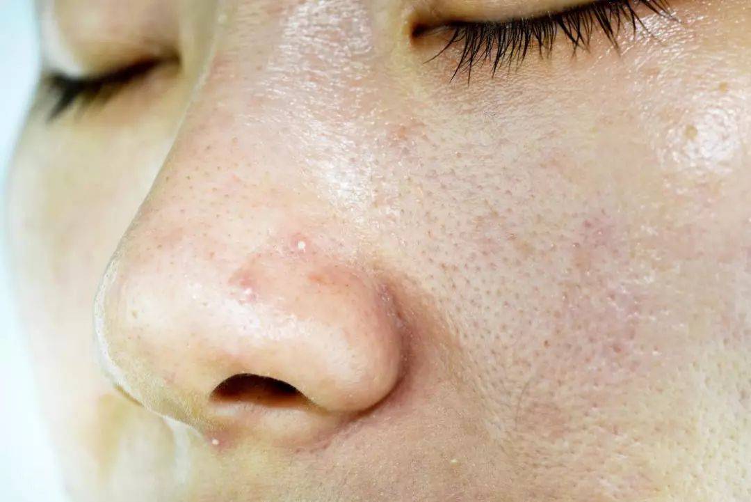 长春肤康医院浅谈:油性皮肤为什么更容易长粉刺?用哪些药物可以治疗?