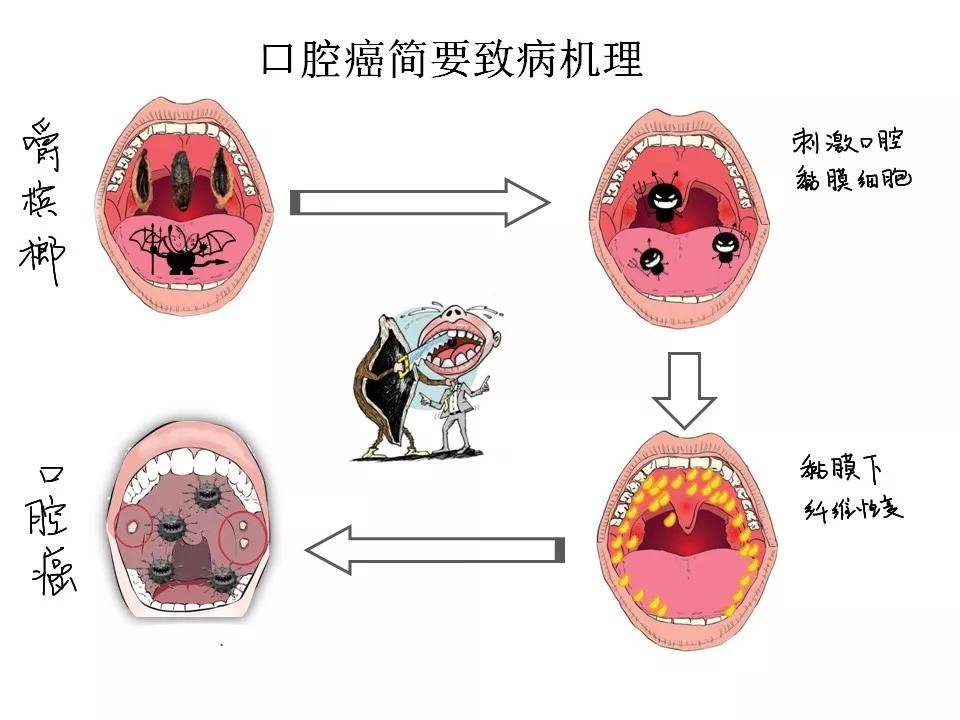 物理损伤:槟榔纤维粗硬,咀嚼的摩擦会造成口腔粘膜的局部外伤和粘膜