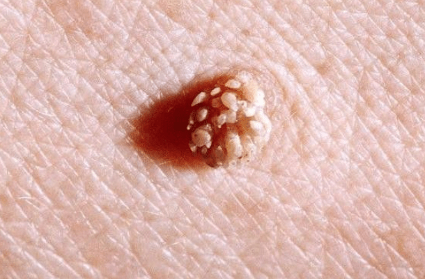 是hpv病毒会寄生在皮肤和黏膜上,引起皮肤出现的凸起物就是疣体,其实