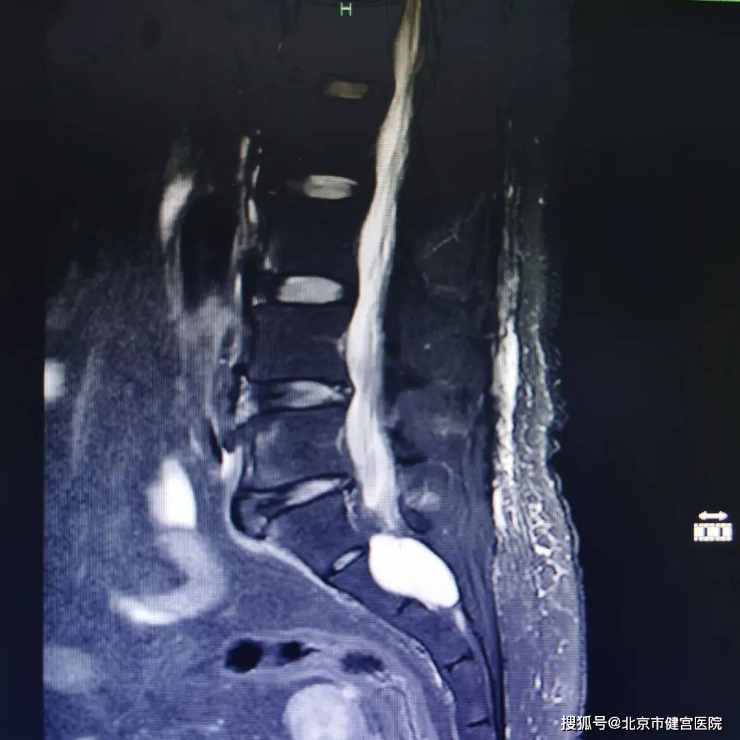 医患同心双下肢无力进行性加重的元凶骶管囊肿