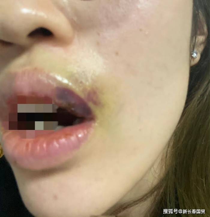 网传吴秀波长子持久家暴女友，女方受伤照片曝光，妇联回应