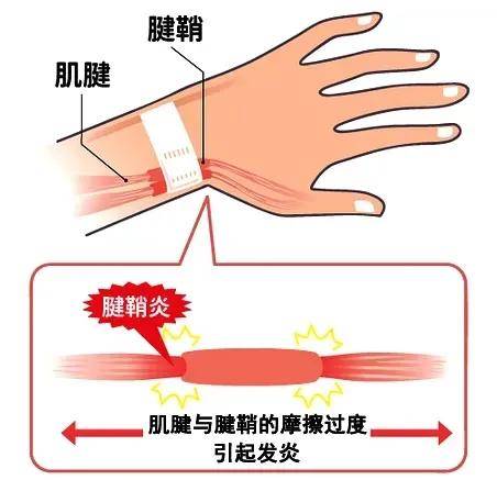 得了腱鞘炎手指酸痛、麻木？想要根除找对方法很重要！！