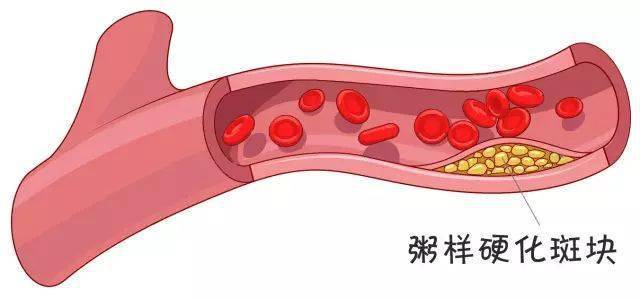 血管堵塞全过程看完记得按时喝水