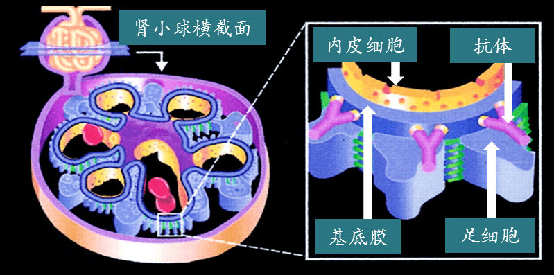 探针资本行业研究抗肾小球基底膜病