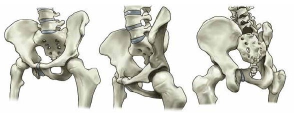 借助3d模型展示差别角度的骨盆形态