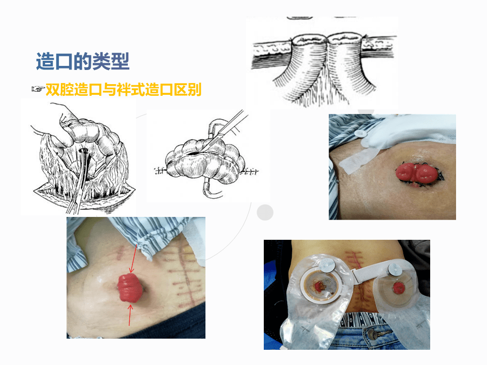 一例结肠癌术后肠造口缺血坏死护理查房